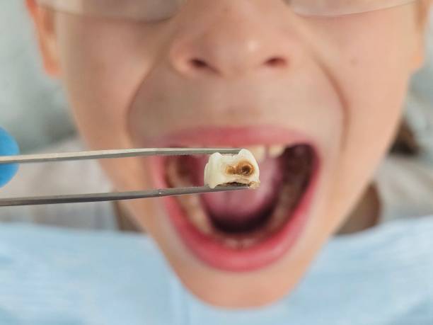Best Emergency Treatment for Toothache in Williamstown, NJ